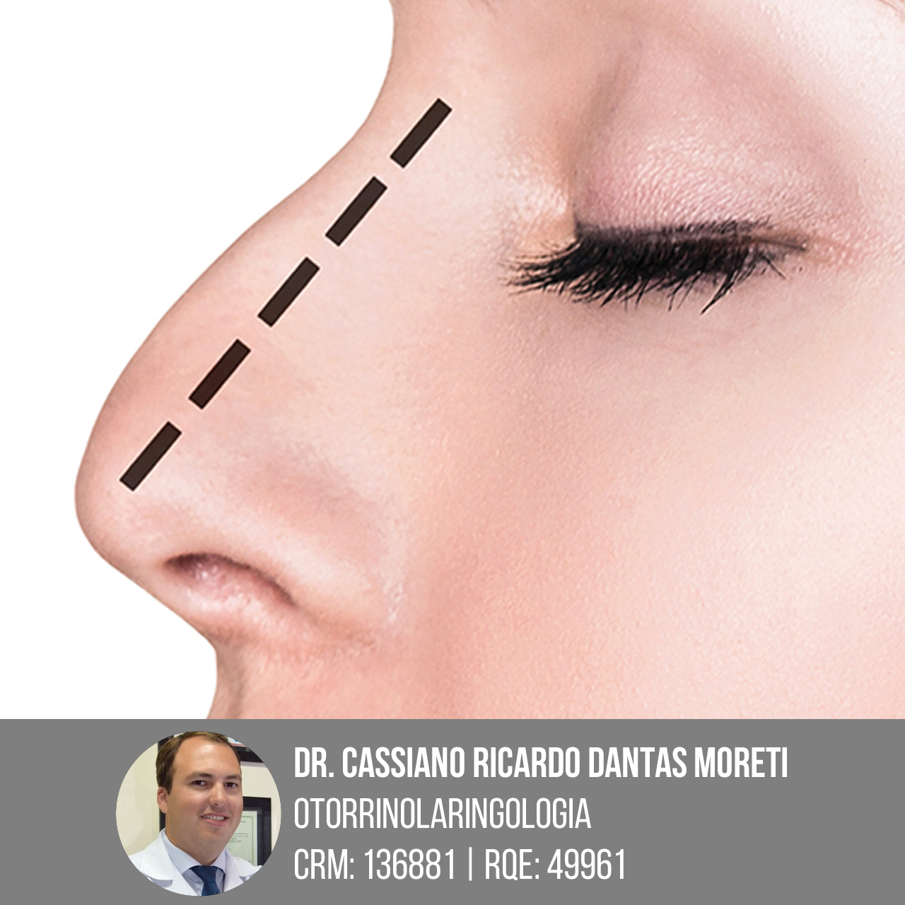 Rinosseptoplastia cirurgia estética/ funcional do nariz
